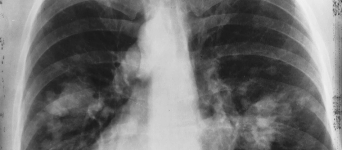 Η πρώτη αιτία θνησιμότητας στην Ελλάδα - Πώς θα μειωθούν οι θάνατοι από αυτήν;